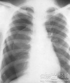 为什么高瘦男性容易得气胸