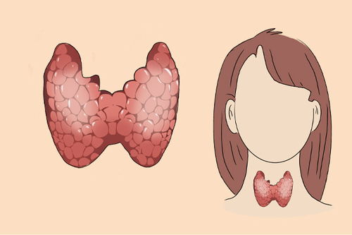 女生确诊甲状腺癌 朋友称其阳光抑郁 女生确诊甲状腺癌 朋友称其阳光抑郁
